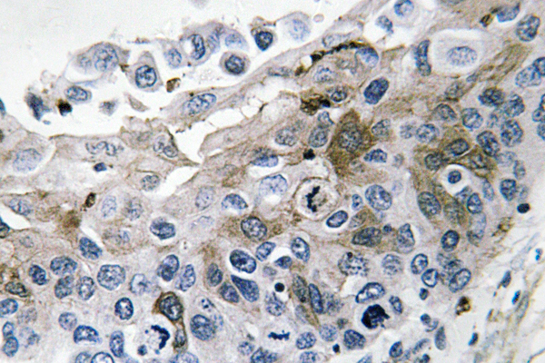 IL-1B / IL-1 Beta Antibody - Immunohistochemistry analysis of IL-1Î² in paraffin-embedded human lung carcinoma tissue.