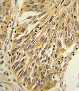 IL-1B / IL-1 Beta Antibody - Formalin-fixed and paraffin-embedded human lung carcinoma with IL1B Antibody , which was peroxidase-conjugated to the secondary antibody, followed by DAB staining. This data demonstrates the use of this antibody for immunohistochemistry; clinical relevance has not been evaluated.
