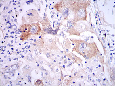 IL-1B / IL-1 Beta Antibody - IHC of paraffin-embedded lung cancer tissues using IL1B mouse monoclonal antibody with DAB staining.