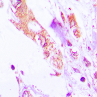 IL-1B / IL-1 Beta Antibody - Immunohistochemical analysis of IL-1 beta staining in human lung cancer formalin fixed paraffin embedded tissue section. The section was pre-treated using heat mediated antigen retrieval with sodium citrate buffer (pH 6.0). The section was then incubated with the antibody at room temperature and detected using an HRP conjugated compact polymer system. DAB was used as the chromogen. The section was then counterstained with hematoxylin and mounted with DPX.