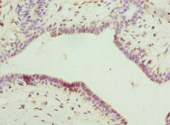 IL-22BP / IL22RA2 Antibody - Immunohistochemistry of paraffin-embedded human breast cancer at dilution 1:100