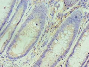 IL10RA Antibody - Immunohistochemistry of paraffin-embedded human colon cancer using antibody at 1:100 dilution.