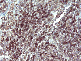 IL10RA Antibody - IHC of paraffin-embedded Human lymphoma tissue using anti-IL10RA mouse monoclonal antibody. (Heat-induced epitope retrieval by 10mM citric buffer, pH6.0, 120°C for 3min). At a dilution of 1:150. 