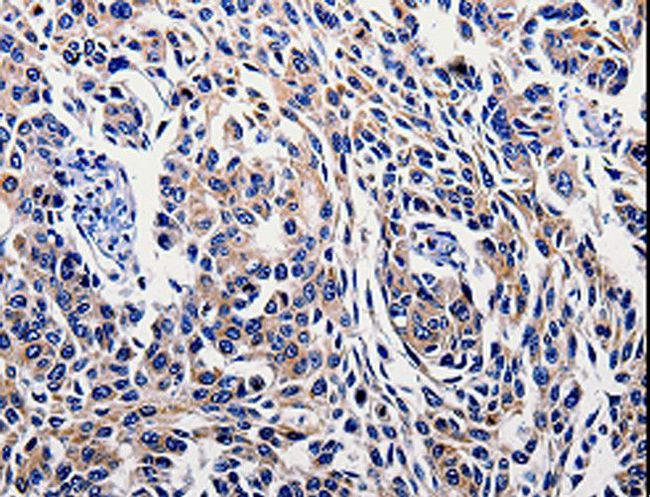 IL10RB Antibody - Immunohistochemistry of paraffin-embedded Human lung cancer using IL10RB Polyclonal Antibody at dilution of 1:60.