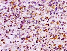 IL10RB Antibody - Immunohistochemistry image at a dilution of 1:100 and staining in paraffin-embedded human glioma cancer performed on a Leica BondTM system. After dewaxing and hydration, antigen retrieval was mediated by high pressure in a citrate buffer (pH 6.0) . Section was blocked with 10% normal goat serum 30min at RT. Then primary antibody (1% BSA) was incubated at 4 °C overnight. The primary is detected by a biotinylated secondary antibody and visualized using an HRP conjugated SP system.