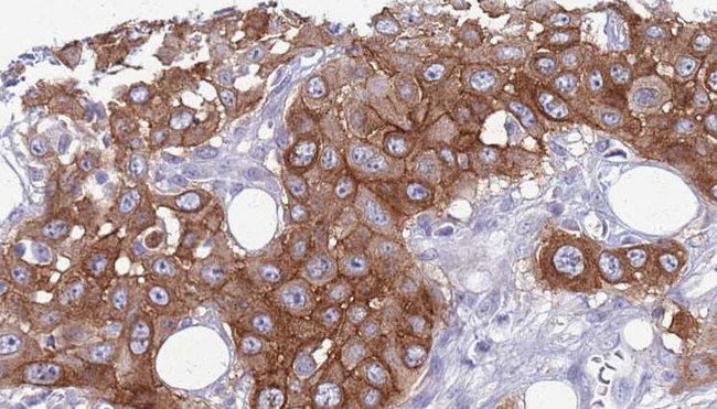 IL11RA Antibody - 1:100 staining human Head and neck carcinoma tissue by IHC-P. The sample was formaldehyde fixed and a heat mediated antigen retrieval step in citrate buffer was performed. The sample was then blocked and incubated with the antibody for 1.5 hours at 22°C. An HRP conjugated goat anti-rabbit antibody was used as the secondary.