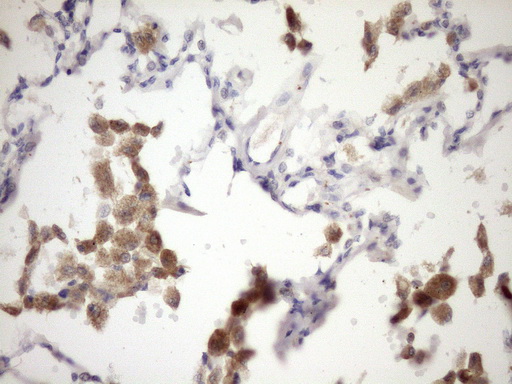 IL12A / p35 Antibody - Immunohistochemical staining of paraffin-embedded Carcinoma of Human lung tissue using anti-IL12A mouse monoclonal antibody. (Heat-induced epitope retrieval by Tris-EDTA, pH8.0)(1:150)