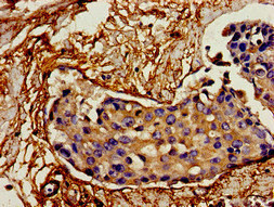 IL12A / p35 Antibody - Immunohistochemistry image of paraffin-embedded human breast cancer at a dilution of 1:100