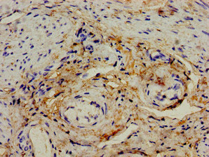 IL12A / p35 Antibody - Immunohistochemistry image of paraffin-embedded human endometrial cancer at a dilution of 1:100