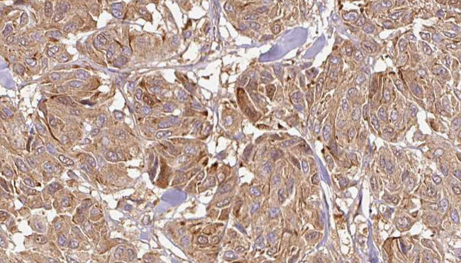 IL12A / p35 Antibody - 1:100 staining human Melanoma tissue by IHC-P. The sample was formaldehyde fixed and a heat mediated antigen retrieval step in citrate buffer was performed. The sample was then blocked and incubated with the antibody for 1.5 hours at 22°C. An HRP conjugated goat anti-rabbit antibody was used as the secondary.