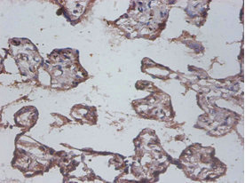 IL12B / IL12 p40 Antibody - Immunohistochemistry of paraffin-embedded human colon cancer using IL12B Antibody at dilution of 1:100