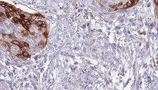 IL12RB1 / CD212 Antibody - 1:100 staining human urothelial carcinoma tissue by IHC-P. The sample was formaldehyde fixed and a heat mediated antigen retrieval step in citrate buffer was performed. The sample was then blocked and incubated with the antibody for 1.5 hours at 22°C. An HRP conjugated goat anti-rabbit antibody was used as the secondary.