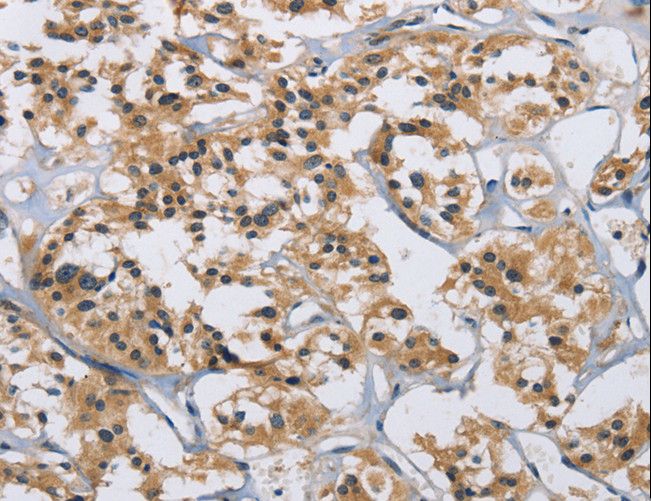 IL12RB2 Antibody - Immunohistochemistry of paraffin-embedded Human thyroid cancer using IL12RB2 Polyclonal Antibody at dilution of 1:40.