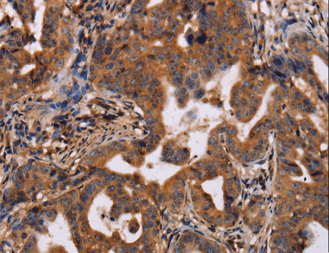 IL12RB2 Antibody - Immunohistochemistry of paraffin-embedded Human prostate cancer using IL12RB2 Polyclonal Antibody at dilution of 1:40.