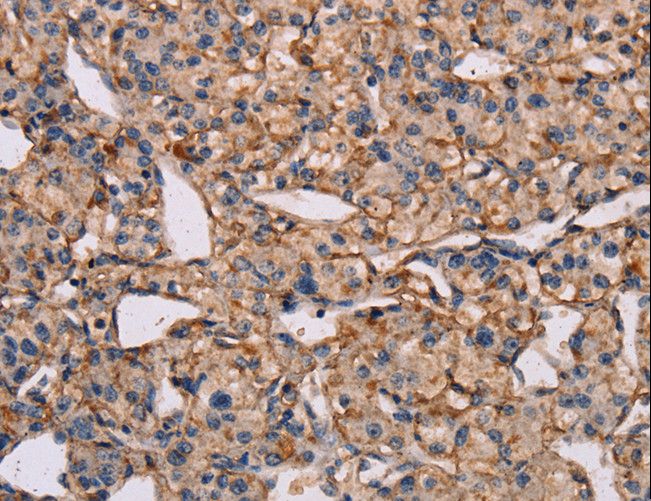 IL12RB2 Antibody - Immunohistochemistry of paraffin-embedded Human prostate cancer using IL12RB2 Polyclonal Antibody at dilution of 1:40.