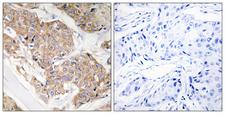 IL13RA1 / IL13R Alpha 1 Antibody - Immunohistochemistry analysis of paraffin-embedded human breast carcinoma tissue, using IL-13R/CD213 alpha1 Antibody. The picture on the right is blocked with the synthesized peptide.