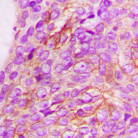 IL13RA1 / IL13R Alpha 1 Antibody - Immunohistochemical analysis of CD213a1 staining in human breast cancer formalin fixed paraffin embedded tissue section. The section was pre-treated using heat mediated antigen retrieval with sodium citrate buffer (pH 6.0). The section was then incubated with the antibody at room temperature and detected using an HRP conjugated compact polymer system. DAB was used as the chromogen. The section was then counterstained with hematoxylin and mounted with DPX.