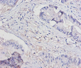 IL15 Antibody - Immunohistochemistry of paraffin-embedded human colon cancer using IL15 Antibody at dilution of 1:100
