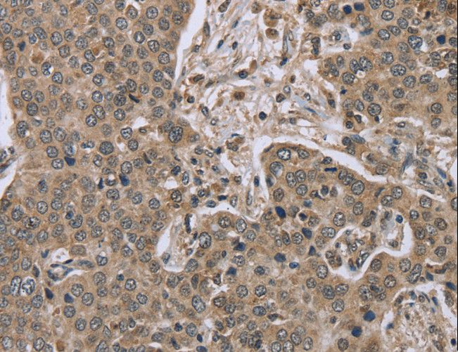 IL15RA Antibody - Immunohistochemistry of paraffin-embedded Human lung cancer using IL15RA Polyclonal Antibody at dilution of 1:45.