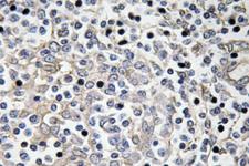 IL16 Antibody - Immunohistochemistry analysis of IL-16 antibody in paraffin-embedded human lung carcinoma tissue.