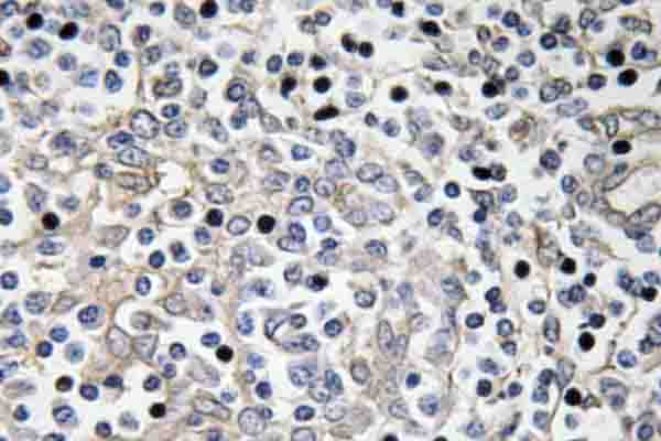 IL16 Antibody - IHC of IL-16 (G97) pAb in paraffin-embedded human lung carcinoma tissue.