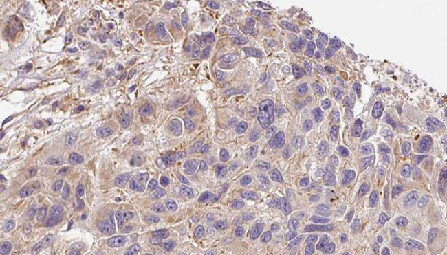 IL17A Antibody - 1:100 staining human Melanoma tissue by IHC-P. The sample was formaldehyde fixed and a heat mediated antigen retrieval step in citrate buffer was performed. The sample was then blocked and incubated with the antibody for 1.5 hours at 22°C. An HRP conjugated goat anti-rabbit antibody was used as the secondary.