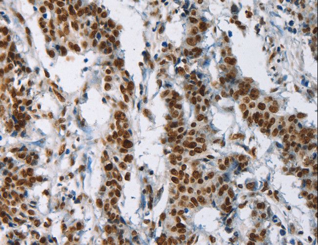 IL17C Antibody - Immunohistochemistry of paraffin-embedded Human gastric cancer using IL17C Polyclonal Antibody at dilution of 1:50.