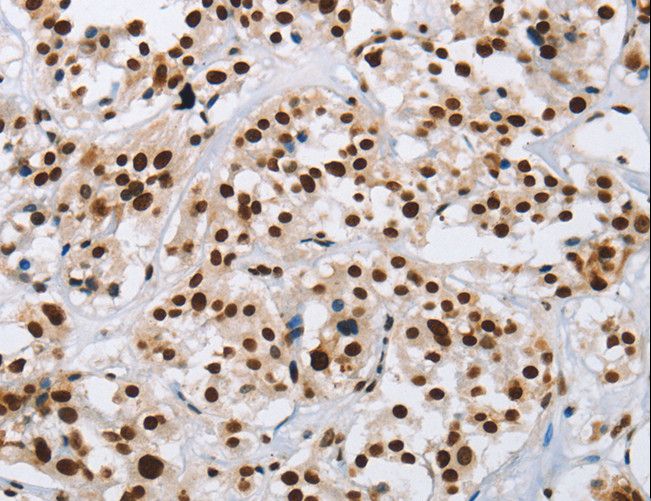IL17C Antibody - Immunohistochemistry of paraffin-embedded Human thyroid cancer using IL17C Polyclonal Antibody at dilution of 1:50.