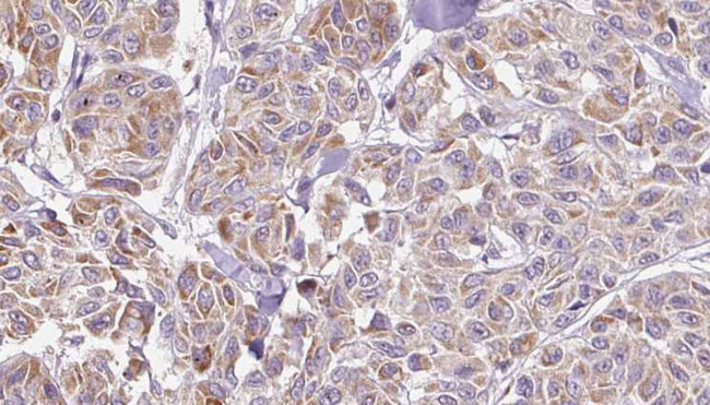 IL17C Antibody - 1:100 staining human Melanoma tissue by IHC-P. The sample was formaldehyde fixed and a heat mediated antigen retrieval step in citrate buffer was performed. The sample was then blocked and incubated with the antibody for 1.5 hours at 22°C. An HRP conjugated goat anti-rabbit antibody was used as the secondary.