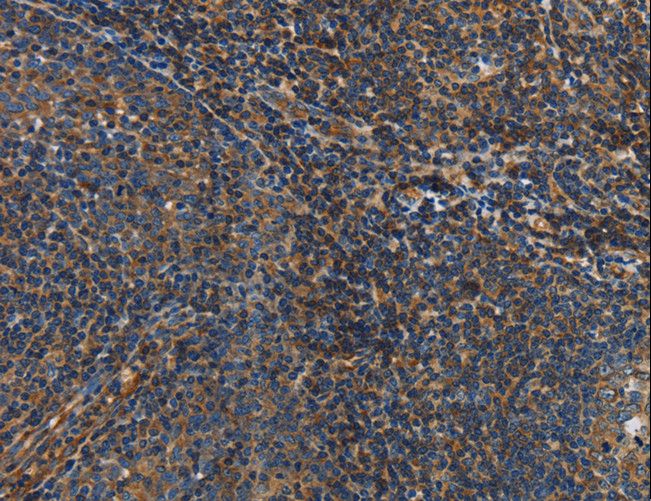 IL17D Antibody - Immunohistochemistry of paraffin-embedded Human gastric cancer using IL17D Polyclonal Antibody at dilution of 1:50.