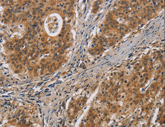 IL17D Antibody - Immunohistochemistry of paraffin-embedded Human gastric cancer using IL17D Polyclonal Antibody at dilution of 1:50.