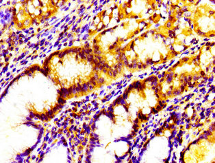 IL17D Antibody - Immunohistochemistry image of paraffin-embedded human gastric cancer at a dilution of 1:100