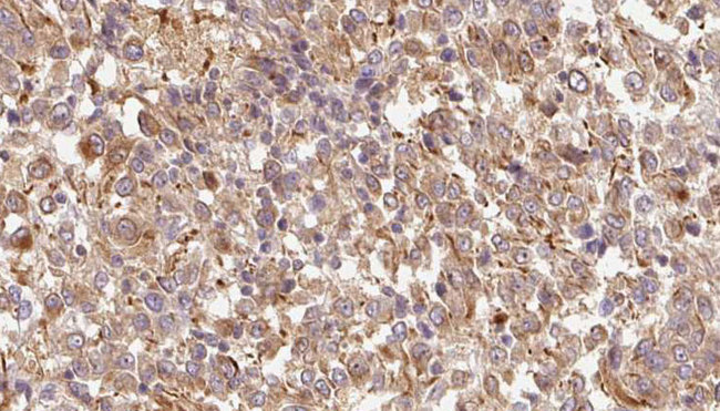 IL17F Antibody - 1:100 staining human Melanoma tissue by IHC-P. The sample was formaldehyde fixed and a heat mediated antigen retrieval step in citrate buffer was performed. The sample was then blocked and incubated with the antibody for 1.5 hours at 22°C. An HRP conjugated goat anti-rabbit antibody was used as the secondary.