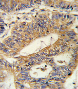 IL17RB Antibody - Formalin-fixed and paraffin-embedded human colon carcinoma reacted with IL17RB Antibody , which was peroxidase-conjugated to the secondary antibody, followed by DAB staining. This data demonstrates the use of this antibody for immunohistochemistry; clinical relevance has not been evaluated.