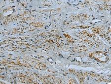 IL17RD Antibody - Immunohistochemistry of paraffin-embedded Human cervical cancer tissue  using IL17RD Polyclonal Antibody at dilution of 1:40(×200)