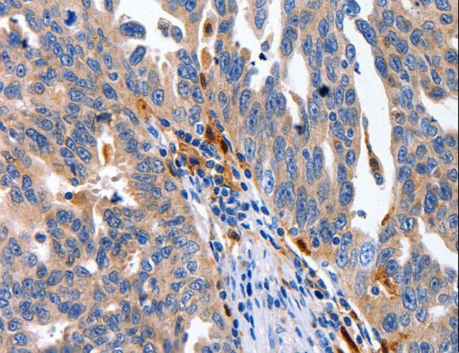 IL18 Antibody - Immunohistochemistry of paraffin-embedded Human ovarian cancer using IL18 Polyclonal Antibody at dilution of 1:100.