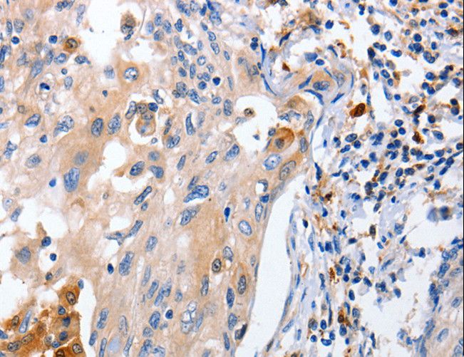 IL18 Antibody - Immunohistochemistry of paraffin-embedded Human cervical cancer using IL18 Polyclonal Antibody at dilution of 1:100.