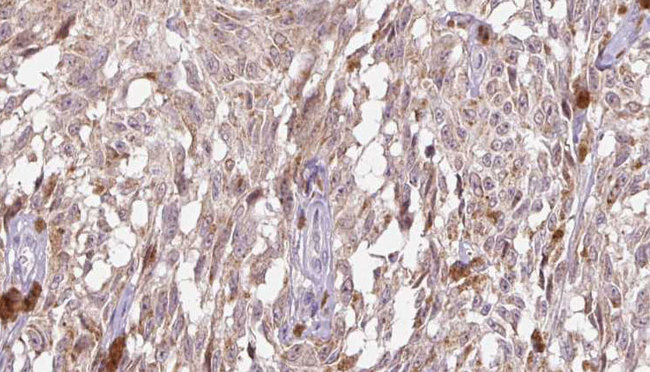 IL18 Antibody - 1:100 staining human Melanoma tissue by IHC-P. The sample was formaldehyde fixed and a heat mediated antigen retrieval step in citrate buffer was performed. The sample was then blocked and incubated with the antibody for 1.5 hours at 22°C. An HRP conjugated goat anti-rabbit antibody was used as the secondary.