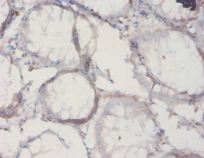 IL18BP Antibody - Immunohistochemistry of paraffin-embedded human colon cancer using Il18bp Antibody at dilution of 1:20