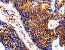 IL18BP Antibody - Immunohistochemistry of paraffin-embedded Human colon cancer using IL18BP Polyclonal Antibody at dilution of 1:50.