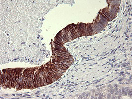 IL1A / IL-1 Alpha Antibody - IHC of paraffin-embedded Carcinoma of Human pancreas tissue using anti-IL1A mouse monoclonal antibody. (Heat-induced epitope retrieval by 10mM citric buffer, pH6.0, 120°C for 3min).