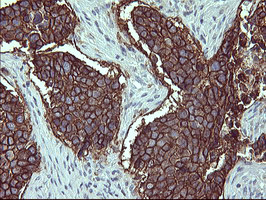 IL1A / IL-1 Alpha Antibody - IHC of paraffin-embedded Carcinoma of Human lung tissue using anti-IL1A mouse monoclonal antibody. (Heat-induced epitope retrieval by 10mM citric buffer, pH6.0, 120°C for 3min).