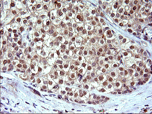 IL1A / IL-1 Alpha Antibody - IHC of paraffin-embedded Carcinoma of Human liver tissue using anti-IL1A mouse monoclonal antibody. (Heat-induced epitope retrieval by 10mM citric buffer, pH6.0, 120°C for 3min).