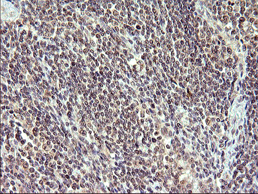 IL1A / IL-1 Alpha Antibody - IHC of paraffin-embedded Human lymphoma tissue using anti-IL1A mouse monoclonal antibody. (Heat-induced epitope retrieval by 10mM citric buffer, pH6.0, 120°C for 3min).