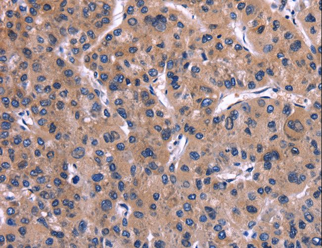 IL1A / IL-1 Alpha Antibody - Immunohistochemistry of paraffin-embedded Human liver cancer using IL1A Polyclonal Antibody at dilution of 1:40.