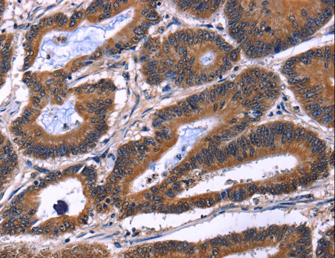 IL1A / IL-1 Alpha Antibody - Immunohistochemistry of paraffin-embedded Human colon cancer using IL1A Polyclonal Antibody at dilution of 1:60.