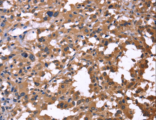 IL1A / IL-1 Alpha Antibody - Immunohistochemistry of paraffin-embedded Human thyroid cancer using IL1A Polyclonal Antibody at dilution of 1:60.