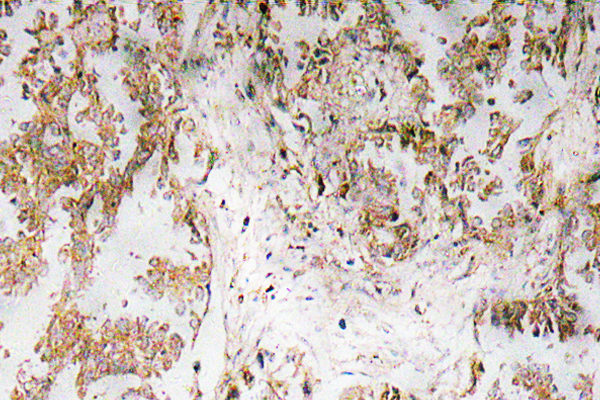 IL1A / IL-1 Alpha Antibody - IHC of IL-1 (F8) pAb in paraffin-embedded human lung carcinoma tissue.