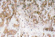 IL1A / IL-1 Alpha Antibody - IHC of IL-1 (F8) pAb in paraffin-embedded human lung carcinoma tissue.