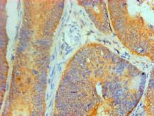 IL1F10 Antibody - Immunohistochemical of paraffin-embedded Human Colon cancer tissue using IL1F10 Monoclonal Antibody at dilution of 1:200.